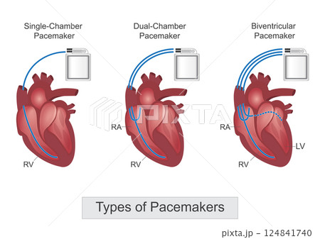Types of pacemaker. 124841740