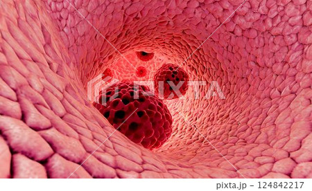 内視鏡で見た大腸など体内に発生した腫瘍、増殖するがん細胞のイメージの3Dイラスト 124842217