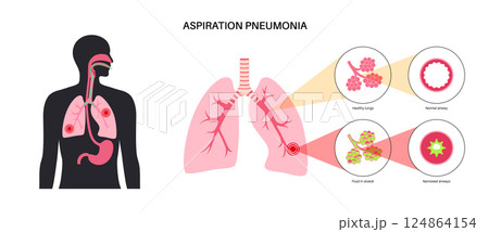 Aspiration pneumonia poster Aspiration pneumonia poster 124864154