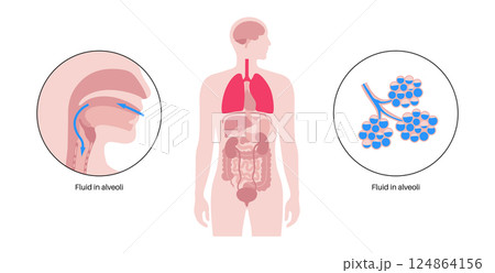 Aspiration pneumonia poster Aspiration pneumonia poster 124864156