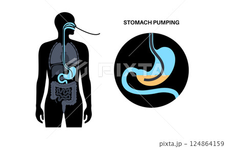 Stomach wash gastric lavage 124864159
