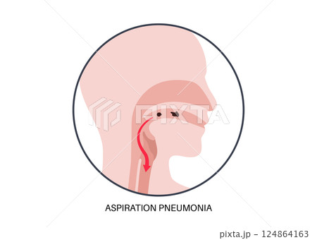 Aspiration pneumonia poster 124864163