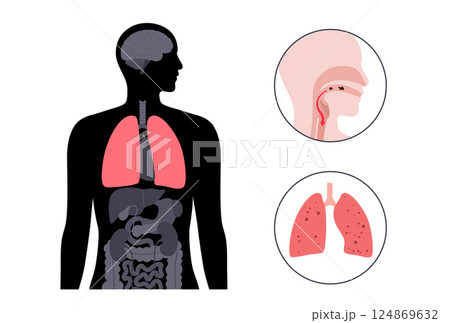 Aspiration pneumonia poster 124869632