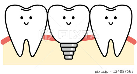 インプラントの歯 インプラントの歯 124887565