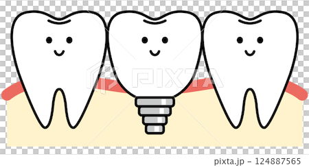 インプラントの歯 インプラントの歯 124887565