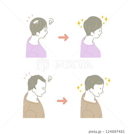 薄毛の男性と女性：治療前と治療後のイラストセット（俯瞰） 124897481
