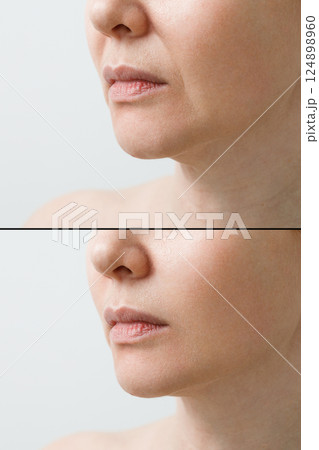 Female nasolabial fold before and after wrinkle smoothing procedures. Correction of the chin and neck shape. Female nasolabial fold before and after wrinkle smoothing procedures. Correction of the chin and neck shape. 124898960