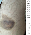 bruise on the leg. hematoma. purple bruise 124902730