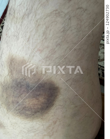 bruise on the leg. hematoma. purple bruise 124902730