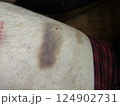 bruise on the leg. hematoma. purple bruise 124902731