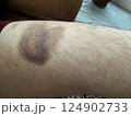 bruise on the leg. hematoma. purple bruise 124902733