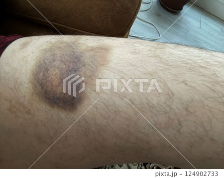 bruise on the leg. hematoma. purple bruise 124902733
