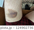 bruise on the leg. hematoma. purple bruise 124902736