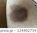 bruise on the leg. hematoma. purple bruise 124902739