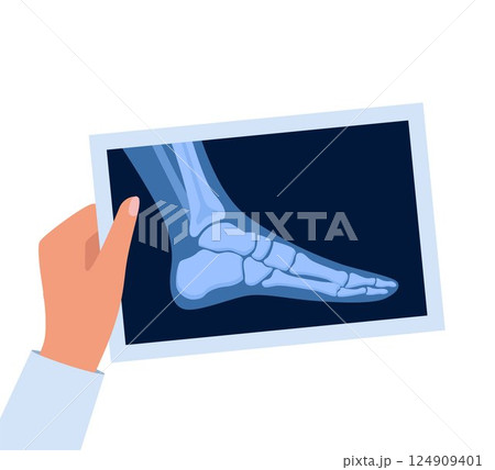 X ray human foot. X-ray picture or radiographic monitor image of metatarsus bones and toes. Medical radiology. Roentgen shot in doctors hand. Vector illustration. 124909401