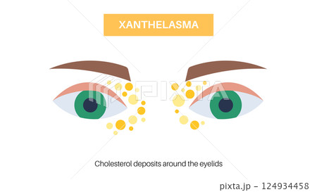 Xanthelasma skin disease 124934458