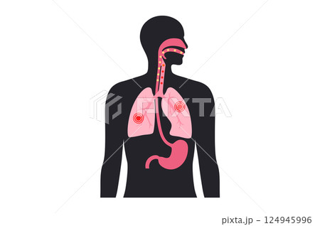 Aspiration pneumonia poster 124945996