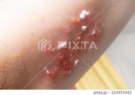 Woman with shingles on the skin she feels very painful 124955942