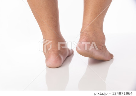 Overweight Senior Women and Ankle Swelling. Overweight Senior Women and Ankle Swelling. 124971964