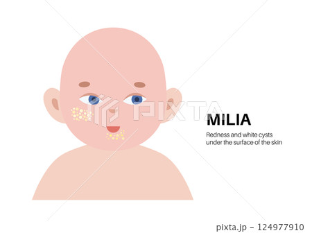 Milia face disease  124977910