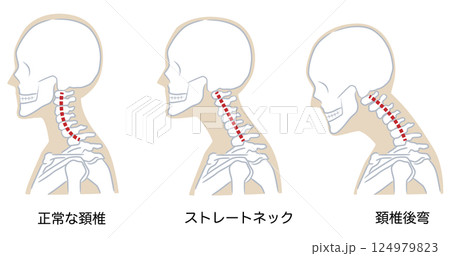 正常な頚椎のカーブとストレートネック、頚椎後弯 正常な頚椎のカーブとストレートネック、頚椎後弯 124979823