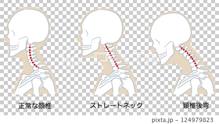 Normal cervical curve, straight neck, cervical kyphosis 124979823