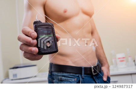 Diabetic man with an insulin pump connected in his abdomen Diabetic man with an insulin pump connected in his abdomen 124987317