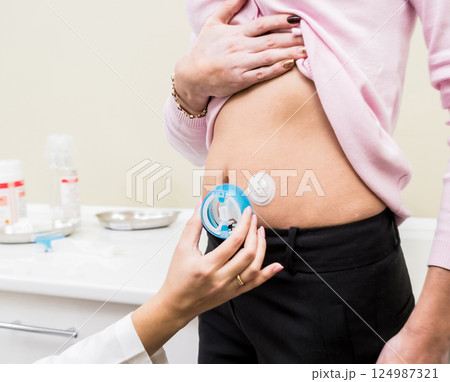 Doctor install patient insulin catheter for a simple injection of insulin. Doctor install patient insulin catheter for a simple injection of insulin. 124987321
