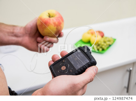 Diabetic man with an insulin pump connected in his abdomen insulin pump 124987474