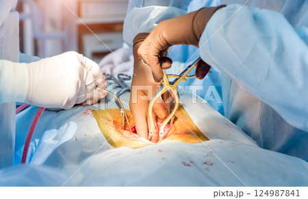 Spinal surgery. Group of surgeons in operating room with surgery equipment. Spinal surgery. Group of surgeons in operating room with surgery equipment. 124987841