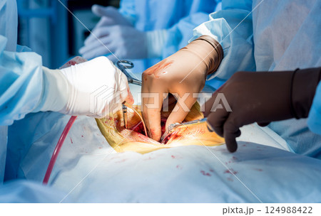 Spinal surgery. Group of surgeons in operating room with surgery equipment.  124988422