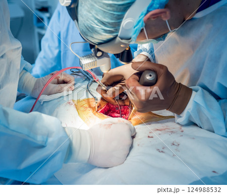 Spinal surgery. Group of surgeons in operating room with surgery equipment. Spinal surgery. Group of surgeons in operating room with surgery equipment. 124988532