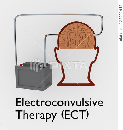Electroconvulsive Therapy concept 125011956