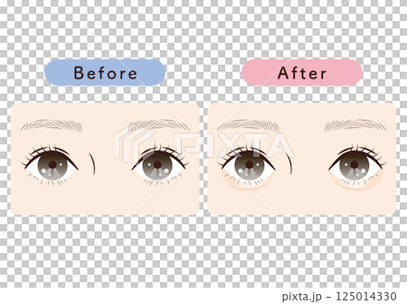 Comparison illustrations with and without tear bags | For reference on how to change the impression of your eyes, plastic surgery, and makeup Comparison illustrations with and without tear bags | For reference on how to change the impression of your eyes, plastic surgery, and makeup 125014330