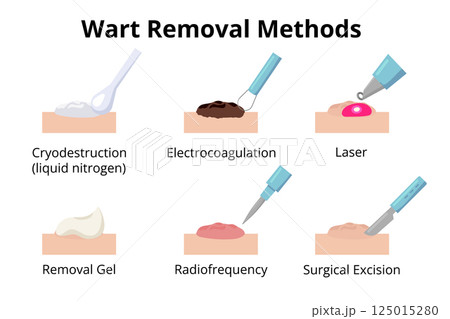 Different wart removal methods illustrations 125015280