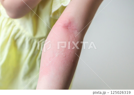 Little girl has skin rash allergy and itchy on her arm 125026319