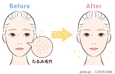 鼻の毛穴トラブル ビフォーアフター|たるみ毛穴 鼻の毛穴トラブル ビフォーアフター|たるみ毛穴 125031066