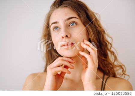 Portrait of a beautiful woman with inflammations on the skin of her face. Medicine and cosmetology. Portrait of a beautiful woman with inflammations on the skin of her face. Medicine and cosmetology. 125033586