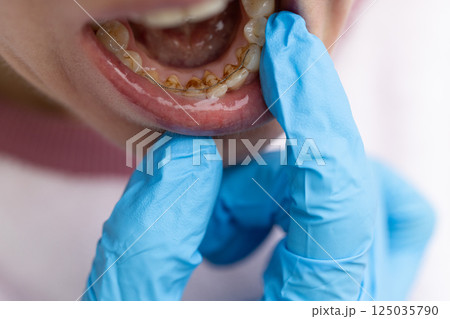 Dentist examining teeth with dental calculus and plaque where also fixed a retainer. Dentist examining teeth with dental calculus and plaque where also fixed a retainer. 125035790