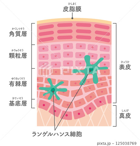 炎症した肌の断面のイラスト/ランゲルハンス細胞の追加(名称あり) 炎症した肌の断面のイラスト/ランゲルハンス細胞の追加(名称あり) 125038769