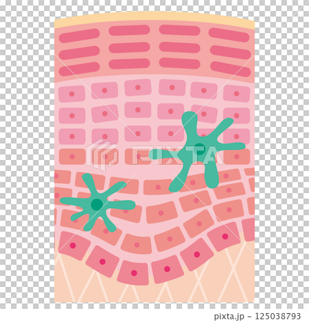 炎症した肌の断面のイラスト／ランゲルハンス細胞の追加（名称なし） 125038793