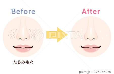 鼻の毛穴トラブル　ビフォーアフター｜たるみ毛穴 125056920