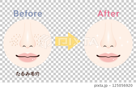 鼻の毛穴トラブル　ビフォーアフター｜たるみ毛穴 125056920
