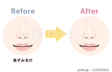 鼻の毛穴トラブル　ビフォーアフター｜黒ずみ毛穴 125056921