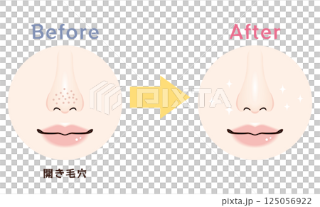 Nose pore problems: before and after | Open pores 125056922