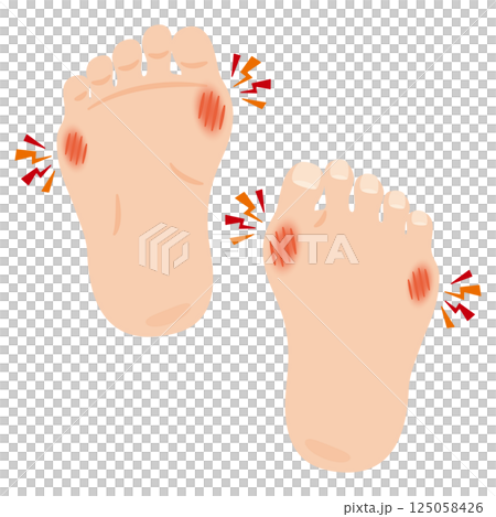 外反母趾のイラスト 外反母趾のイラスト 125058426