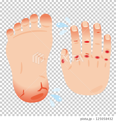 Illustration of the soles of the feet and the backs of the hands with inflammation such as chapped skin and cracks 125058432