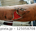 A large wound where the flesh inside can be seen 125058708