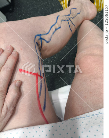 Unrecognizable patient prepared for varicose vein operation. Saphenus vein. Unrecognizable patient prepared for varicose vein operation. Saphenus vein. 125061157