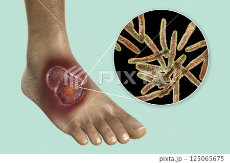 Buruli ulcer on a patient foot, 3D illustration. The disease caused by Mycobacterium ulcerans bacteria 125065675